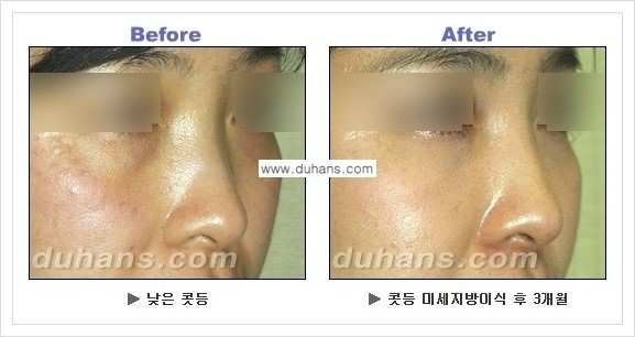 [두한성형외과 경쟁력 코성형] - [코높힘 미세지방이식 정보 안내] 관련 이미지 14