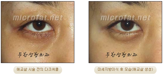 Duhan Plastic Surgery Under-Eye Surgery - Correction with Fat Grafting After Aegyo-Sal Filler image 25