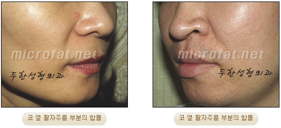 [두한성형외과 지방이식] - [귀족수술과 인디언밴드 교정] 관련 이미지 2