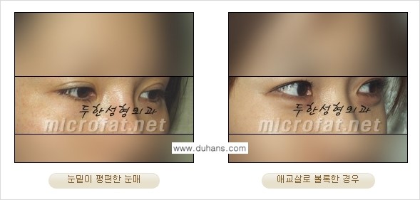 [두한성형외과 경쟁력 눈밑성형] - [눈밑 다크써클과 눈밑 애교살과의 관계 1.] 관련 이미지 2