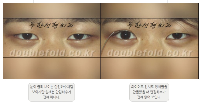 [Ptosis, Duhan Plastic Surgery] - [Sleepy-Looking Eyes, Ptosis Eye Correction] image 4