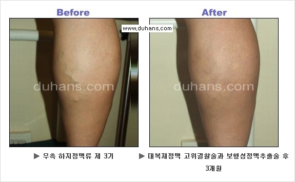 [두한성형외과 경쟁력 정맥류 치료] - [정맥류 치료의 모든 것] 관련 이미지 23
