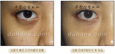 두한성형외과 눈밑성형 - 눈밑지방제거, 눈밑주름, 눈밑지방재배치 관련 이미지 89