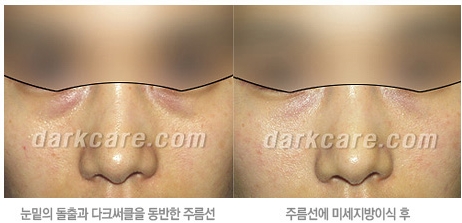 [두한성형외과 눈밑성형] - [무흉터 눈밑지방제거] 관련 이미지 11