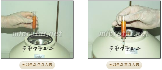 Wrinkle Improvement, Duhan Plastic Surgery - Mouth Lines, Nasolabial Folds image 5
