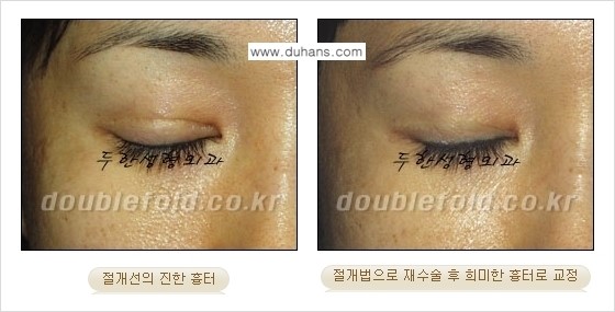 [두한성형외과 경쟁력 쌍꺼풀 재수술] - [흉터선이 진한 경우] 관련 이미지 7