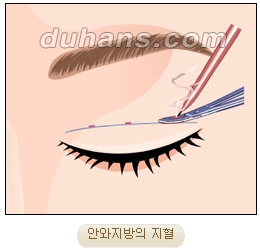 눈성형잘하는곳 두한성형외과 - 겹쌍꺼풀 관련 이미지 12