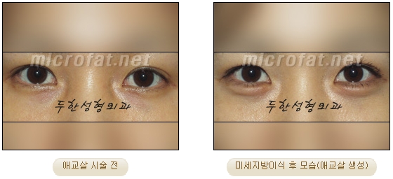 ​[두한성형외과 지방이식] - [애교살] 관련 이미지 9