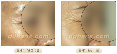 [두한성형외과 주름개선] - [주름교정 방법] 관련 이미지 5