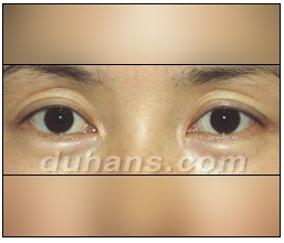Candidates for Double Eyelid Revision Surgery: Unattractive Double Eyelids, Beautiful Double Eyelids image 24