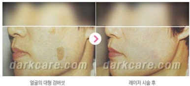 [눈밑수술 두한성형외과] - [다크서클 콤비프로그램] 관련 이미지 166