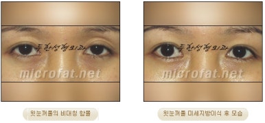[Doohan Plastic Surgery Autologous Fat Grafting] - [Sunken Eye Fat Grafting] image 25