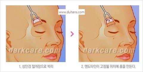 [두한성형외과 경쟁력 Quick 주름성형] - [주름제거, 탄력증대! 리프팅 시리즈 안내] 관련 이미지 27