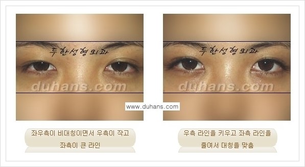 [두한성형외과 경쟁력 쌍꺼풀 재수술, 극한 재수술] - [비대칭(짝짝이) 쌍꺼풀 라인 교정 안내] 관련 이미지 4