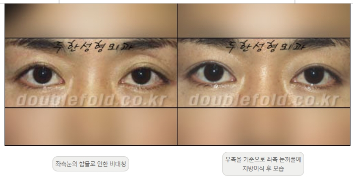 [두한성형외과 쌍커플재수술] - [비대칭 쌍커풀 라인] 관련 이미지 20