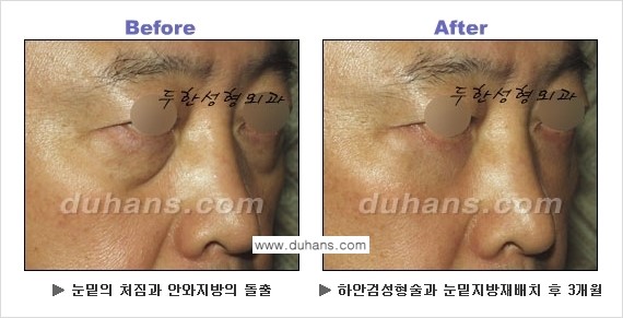 [두한성형외과의 상큼하고 환한 젊은 눈매완성] - [하안검 성형술 ②] 관련 이미지 24