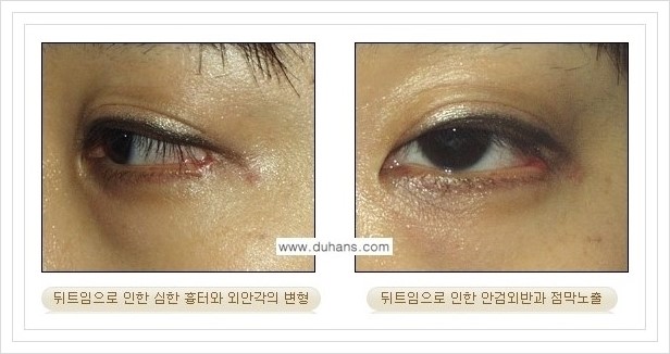 [두한성형외과 경쟁력 쌍꺼풀 재수술, 극한 재수술] - [뒤트임 수술에 대한 안내] 관련 이미지 8