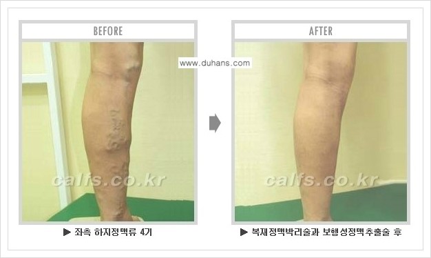 ​⁠[두한성형외과 경쟁력 정맥류 치료] - [하지정맥류 사진 자료 안내 2.] 관련 이미지 14