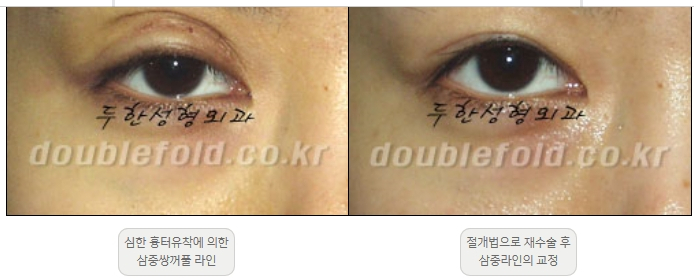 [Double Eyelid Surgery Duhan Plastic Surgery] - [Revision Methods] image 21