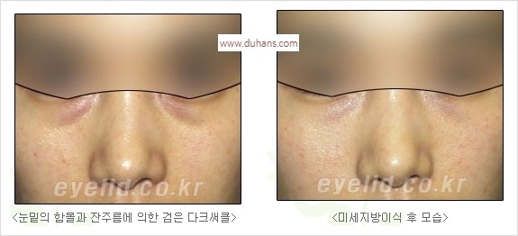 [두한성형외과 경쟁력 눈밑성형] - [눈밑 다크써클 수술 방법] 관련 이미지 16