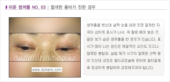 [두한성형외과 경쟁력 눈성형] - [미운 쌍꺼풀이란?] 관련 이미지 4