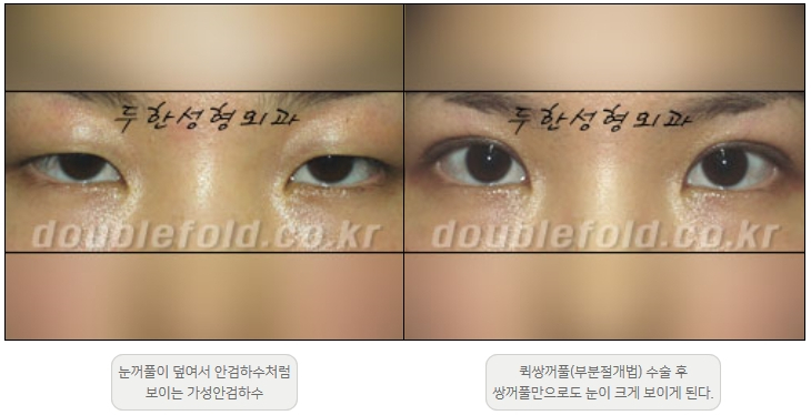 [Ptosis, Duhan Plastic Surgery] - [Sleepy-Looking Eyes, Ptosis Eye Correction] image 22