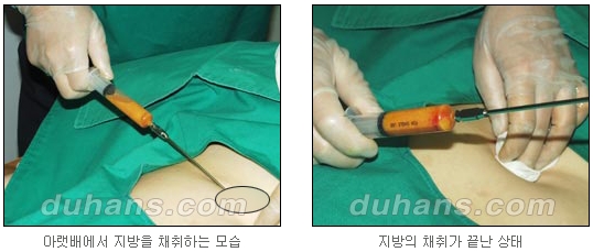 [두한성형외과 얼굴자가지방이식] - [귀족수술 입체 미세지방이식] 관련 이미지 7