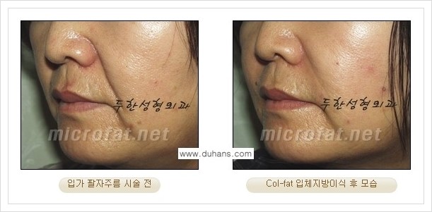 [두한성형외과 경쟁력 미세지방이식] - [상표등록 "Col-fat(콜펫) 지방이식"의 장점 안내] 관련 이미지 7
