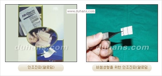 [두한성형외과 경쟁력 코성형] - [실리콘, 알로덤, 미세지방이식을 이용한 맞춤 코성형] 관련 이미지 11