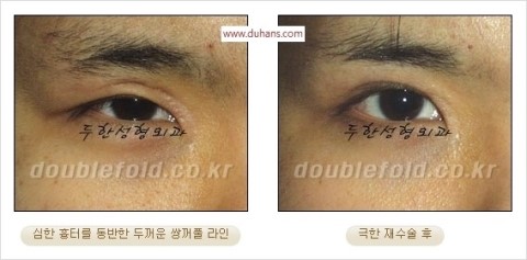 ​[두한성형외과 눈재수술] - [앞트임복원, 뒤트임복원, 쌍꺼풀복원] 관련 이미지 34
