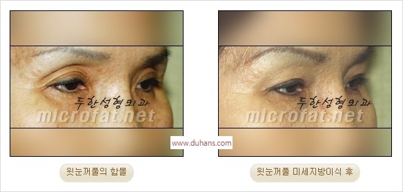 [두한성형외과 경쟁력 지방이식] - [두한 자가지방이식 클리닉 안내]​ 관련 이미지 37