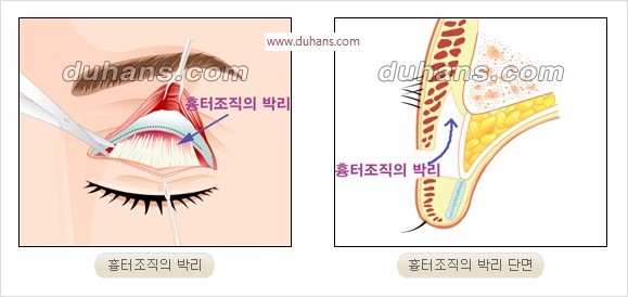 [두한성형외과 경쟁력 쌍꺼풀 재수술] - [완전절개법(Full incision method), 부분절개법(Partial incision method) 재수술] 관련 이미지 5