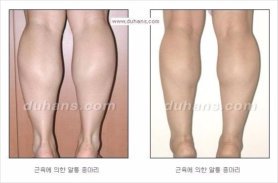 [두한성형외과 경쟁력 멀티종아리성형] -  [종아리 축소술의 여러 가지 종류] 관련 이미지 8
