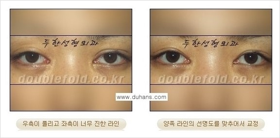 [두한성형외과 경쟁력 쌍꺼풀 재수술] - [짝짝이 쌍꺼풀 라인 교정] 관련 이미지 5