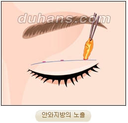 눈성형잘하는곳 두한성형외과 - 겹쌍꺼풀 관련 이미지 10