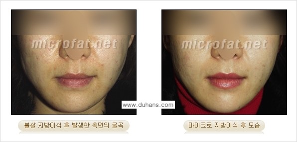 [두한성형외과 경쟁력 미세지방이식] - [지방이식 부작용 - 지방이식 후 발생한 굴곡현상에 대한 안내] 관련 이미지 1