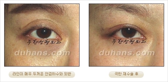 [두한성형외과 경쟁력 쌍꺼풀 재수술 리더 ] - [쌍꺼풀 재수술 과정, 쌍꺼풀 재수술 실패의 원인, 극한 재수술] 관련 이미지 26