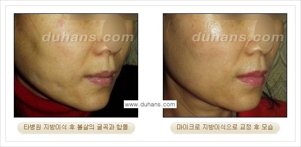 [두한성형외과 경쟁력 얼굴 미세지방이식] - [타병원에서 지방이식 후 굴곡과 과주입 교정 안내] 관련 이미지 4