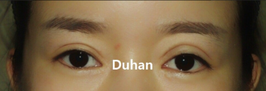 [Duhan Plastic Surgery Secondary Double Eyelid Surgery] - [Sleepy Eye Appearance, Asymmetrical Eye Appearance, Ptosis] image 1