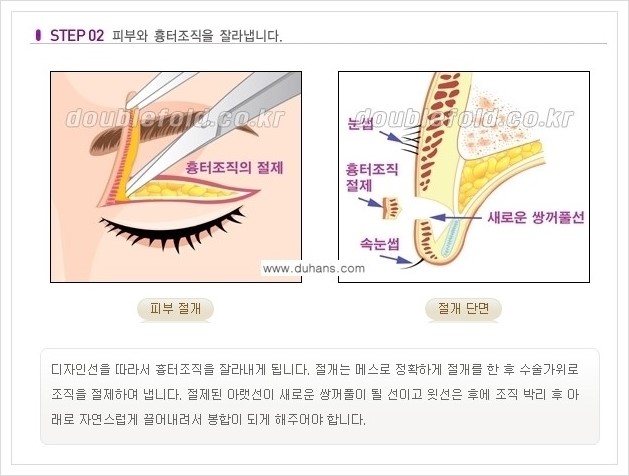 [두한성형외과 경쟁력 쌍꺼풀 재수술, 극한 재수술] - [쌍꺼풀 재수술의 과정 안내 1.] 관련 이미지 2