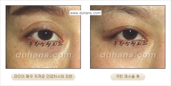 ⁠⁠⁠⁠[두한성형외과 성형 FOCUS] - [정상적인 눈매로의 복원 극한재수술 경우 ①] 관련 이미지 1