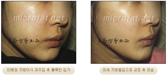 얼굴지방이식 두한성형외과 - 볼지방이식 관련 이미지 41