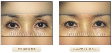 [Duhan Plastic Surgery Micro Fat Grafting] - [Upper Eyelids] image 12