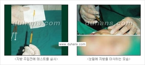 [두한성형외과 경쟁력 미세지방이식] - [다크써클 & 눈밑주름 미세지방이식 2.] 관련 이미지 5