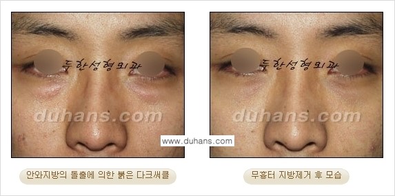 [두한성형외과 젊은 눈매 안검성형] - [눈밑 지방제거의 수술 전후 안내 ②] 관련 이미지 10