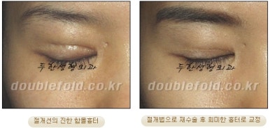 [두한성형외과 쌍커풀재수술] - [심한 소세지눈, 두줄따기, 쌍꺼풀 흉터] 관련 이미지 41