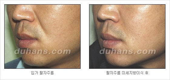 [두한성형외과 경쟁력 주름성형] - [세월의 흔적! 주름을 교정하는 여러 가지 교정 방법] 관련 이미지 26
