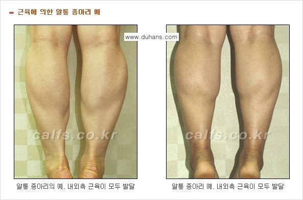 [두한성형외과] - [가을엔 아름답고 매끈한 다리 도전!​] 관련 이미지 5