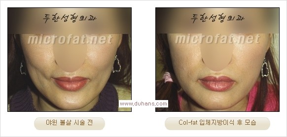 [두한성형외과 경쟁력 지방이식] - [두한 자가지방이식 클리닉 안내]​ 관련 이미지 45