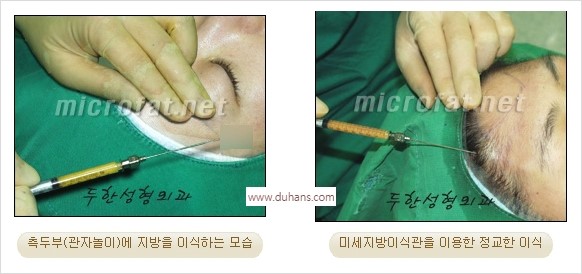 [두한성형외과 경쟁력 미세지방이식] - [관자놀이(측두부) 지방이식] 관련 이미지 5
